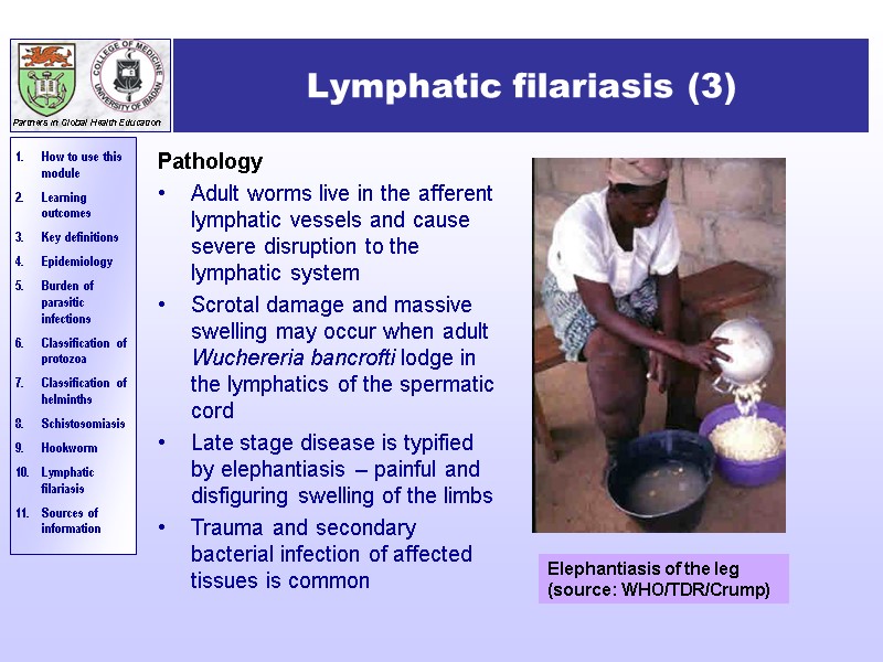 Lymphatic filariasis (3) Pathology Adult worms live in the afferent lymphatic vessels and cause